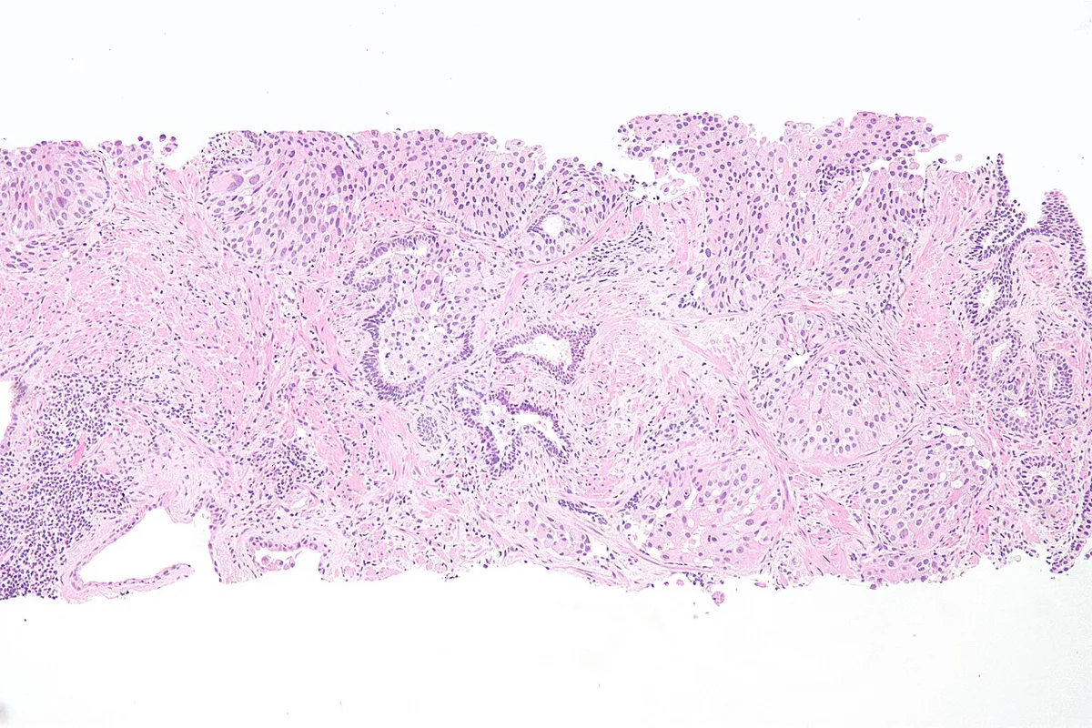 transitional cell carcinoma